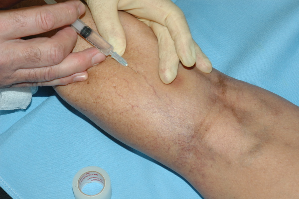 Say Goodbye To Varicose Veins In 2015 With Powerful Treatment Known As Sclerotherapy