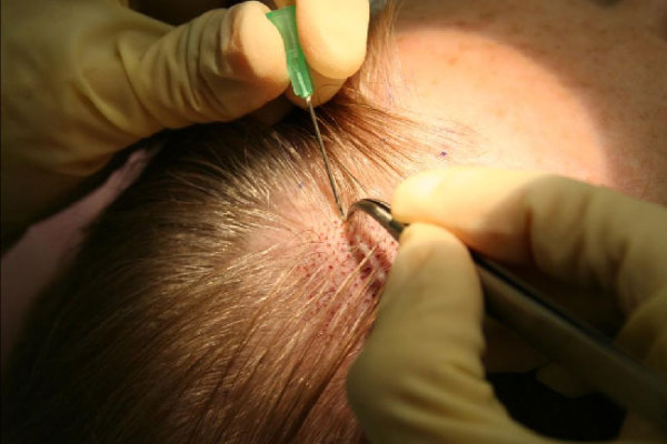 10 Possible Side-Effects Of Hair Transplant You Probably Didn't Know Of