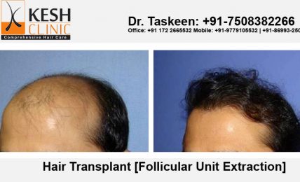 Hair Transplant- The Ultimate Solution Of Baldness