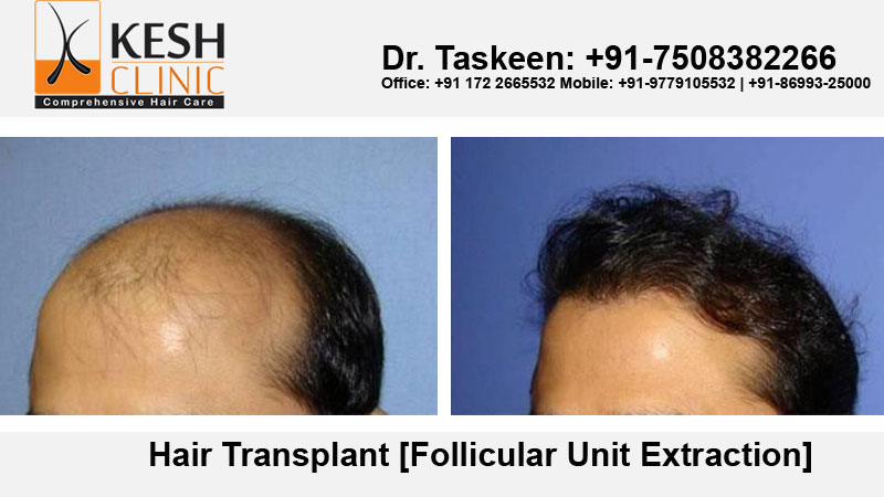 Hair Transplant- The Ultimate Solution Of Baldness