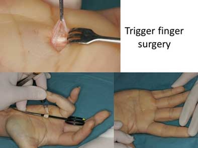 Why Do You Need Trigger Finger Surgery?