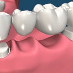 Top 5 Benefits Of Dental Bridges