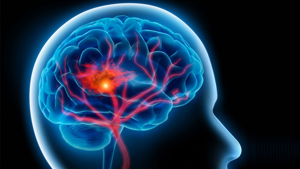 A Complete Guide On Brain Stroke and Its Symptoms
