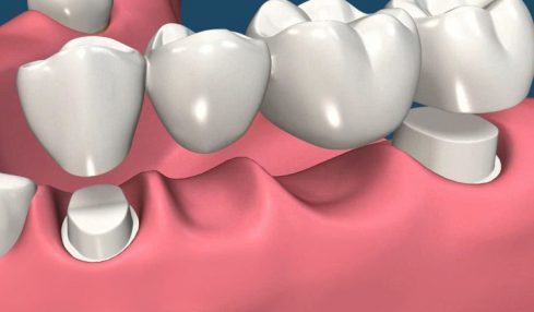 Crowns and Bridges- Restructure and Restore Your Smile