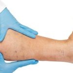 Venous Leg Ulcer And Its Treatment