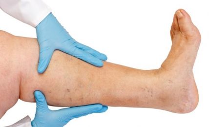 Venous Leg Ulcer And Its Treatment