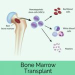 Everything You Need To Know About Your Bone Marrow Transplantation