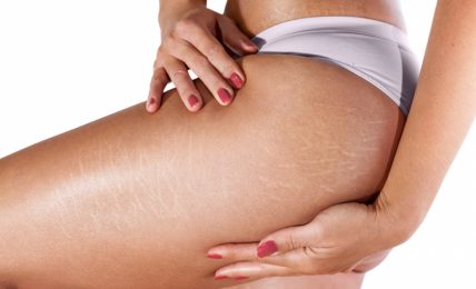 6 Natural Ways To Reduce Stretch Marks