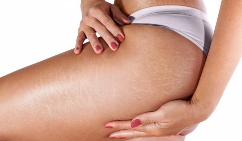 6 Natural Ways To Reduce Stretch Marks
